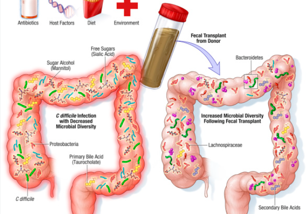 What is the Fecal Microbiota Transplantation?