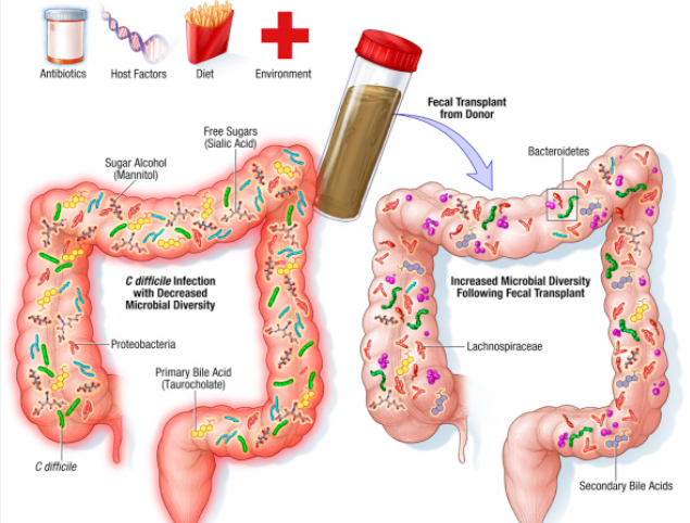 What is the Fecal Microbiota Transplantation?