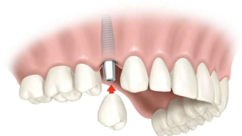 The Hidden Workload in Implant Follow-Ups — How Clinicians Manage It